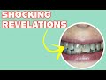 Why your teeth turn black causes of blackened teeth