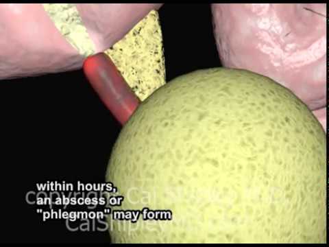 Appendicitis - Cause, Diagnosis and Treatment Animation by Cal Shipley, M.D.