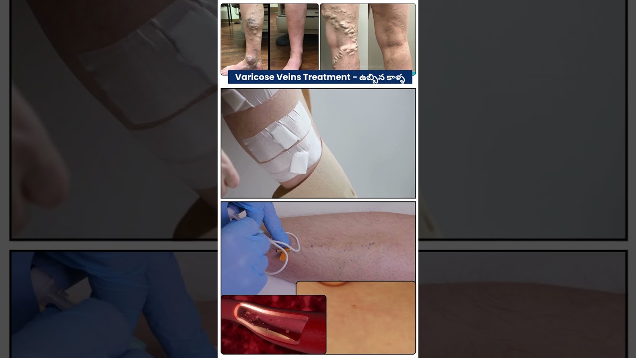 Laser Treatment for Varicose Veins | No Surgery | Leg Pain Relief #shorts