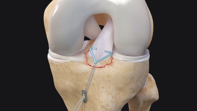 Tibial Spine Fractures  Florida Orthopaedic Institute