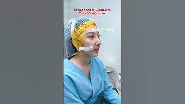 Combo nâng mũi, độn cằm. Thay đổi diện mạo🥰 #nangmuicautruc #lamdep #doncam #xuhuong #thinhhanh