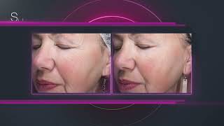 New Facial Treatment by Candela (3d animation 2023) by Arcreative 1,440 views 1 year ago 3 minutes, 30 seconds