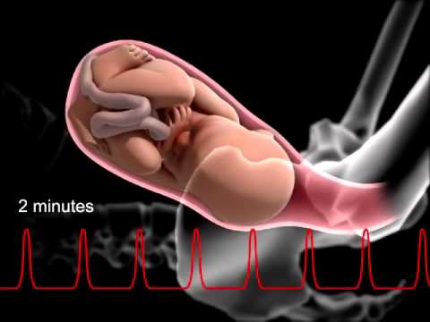 Vidéo: Les bébés par le siège arrivent-ils plus tôt ?