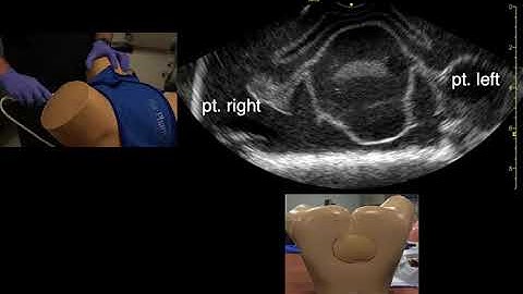 Ultrasound of the Female Pelvis, Endovaginal Scanning Technique