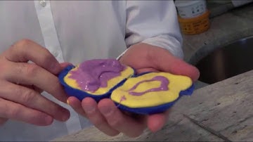 Step #4 Duplicating the existing converted denture or PMMA that is currently in the mouth.