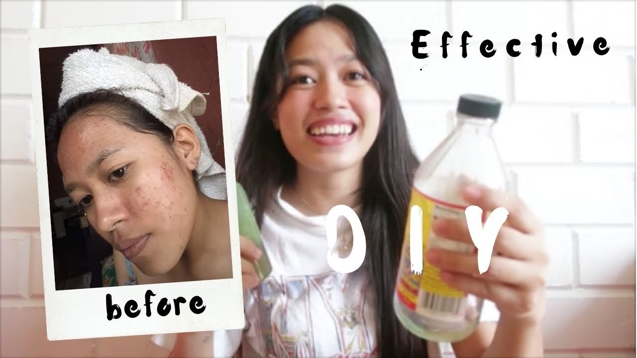 HOMEMADE FACE MIST (FOR ACNE PRONE AND OILY SKIN) YouTube