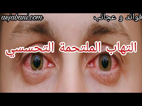 التهاب الملتحمة التحسسي   الأسباب والأعراض والعلاج