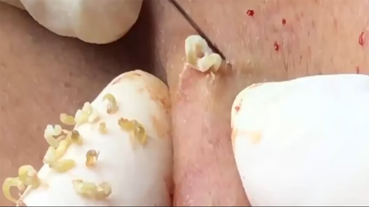 Dr Pimple Popper Blackhead Removal