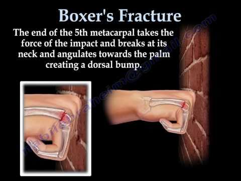 Boxer's Fracture - Everything You Need To Know - Dr. Nabil Ebraheim -  YouTube