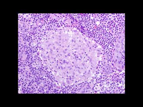 Natural Remedy For Liver Calcification Natural Remedy For Liver Calcification