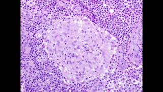Granulomatous Disease - Causes