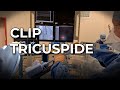 Clip tricuspide
