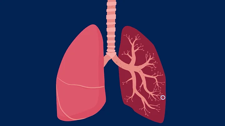 How Particle Pollution Impacts Your Lung