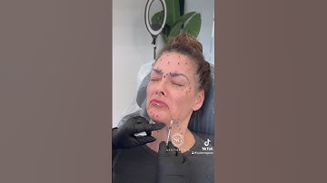 Full face botox injections. Results at the end