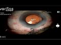Live Surgical Demonstration: Femto Laser–Assisted Cataract Surgery with Eyhance IOL Dr Gaurav Luthra