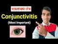 Conjunctivitis in hindi  conjunctivitis shalakya tantra  shalakya tantra  easy simple tricks 
