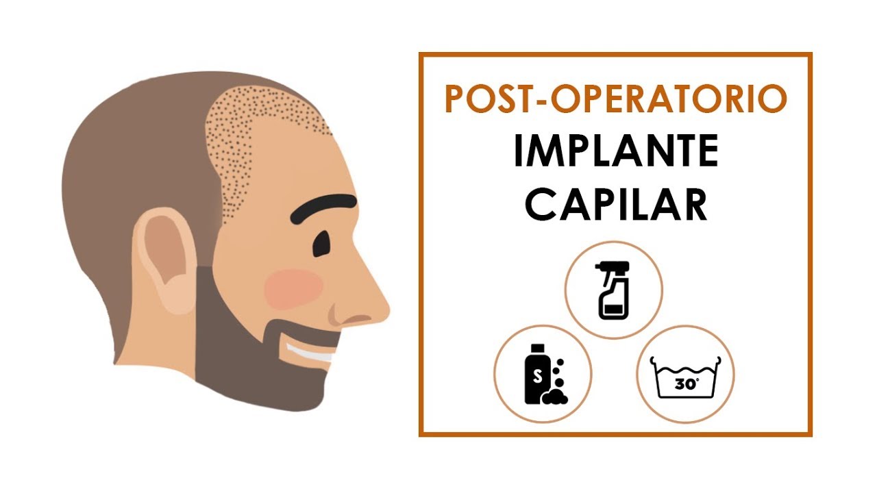 Implante Capilar 5