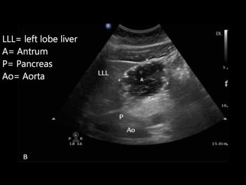 Gastric ultrasound for preoperative assessment