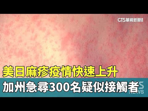 美日麻疹疫情快速上升 加州急尋300名疑似接觸者｜華視新聞 20240313