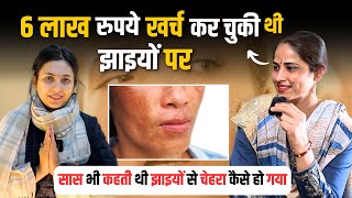 सास भी कहती थी झाइयों से चेहरा कैसा हो गया है ? How to treat Pigmentation | Dr. Upasana Vohra