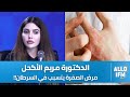 د مريم الاكحل مرض الصفرة موش معدي لكن ينجم يكون مخطر وهذه أهم أعراضو 