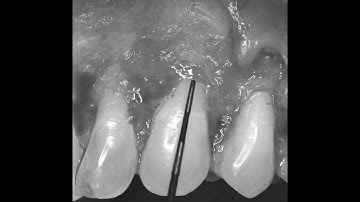 Esthetic crown lengthening: MUST know "SCTA" HEALING timing