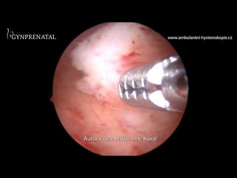 Video: Hysteroskopické Odstránenie Polypov Endometria