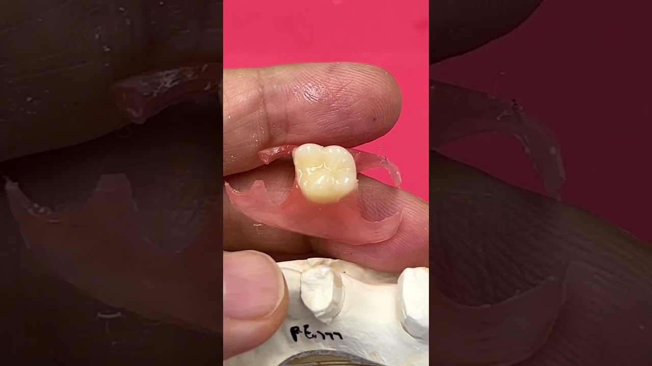 Replacing an Old Metal Crown with a Nesbit Partial