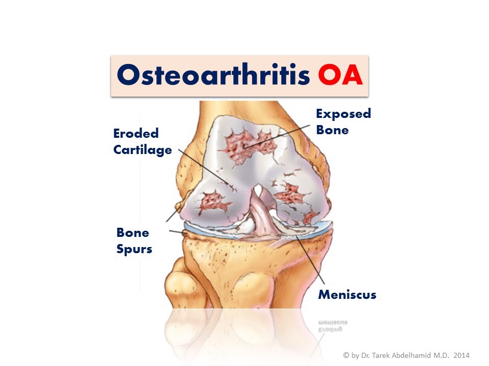 csípőzsír kezelés osteoarthritis