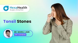 What Are Tonsil Stones? Hexahealth Expert