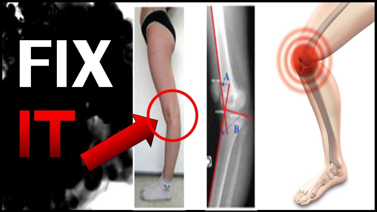 호주 물리치료사의 반장슬(Back knee) 체형교정루틴 (휜다리 교정법) (eng sub)