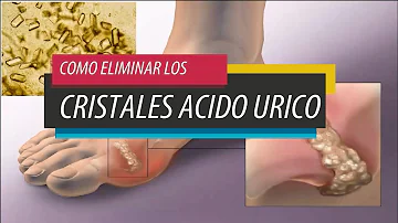 ¿Cómo eliminar los cristales de ácido úrico en las articulaciones?