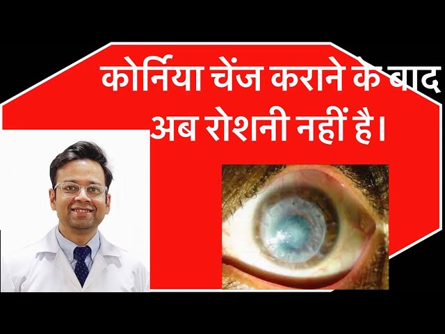 कोर्निया ट्रांस्प्लांट के बाद अब नहीं दिखता।#cornealtransplant #cornea