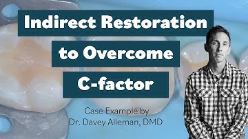 Indirect Restoration to Overcome C Factor: Case Example