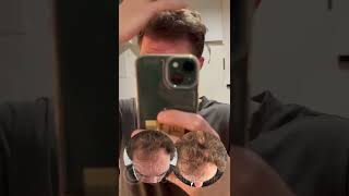 Our patient's results after hairtransplant