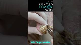 Nails fungus #foot #footcare #podologos #orthotics #calluses #feet #footpain #athlete #podiatrist