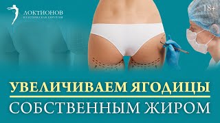Липомоделирование ягодиц / В чем заключен смысл данной операции? /18+