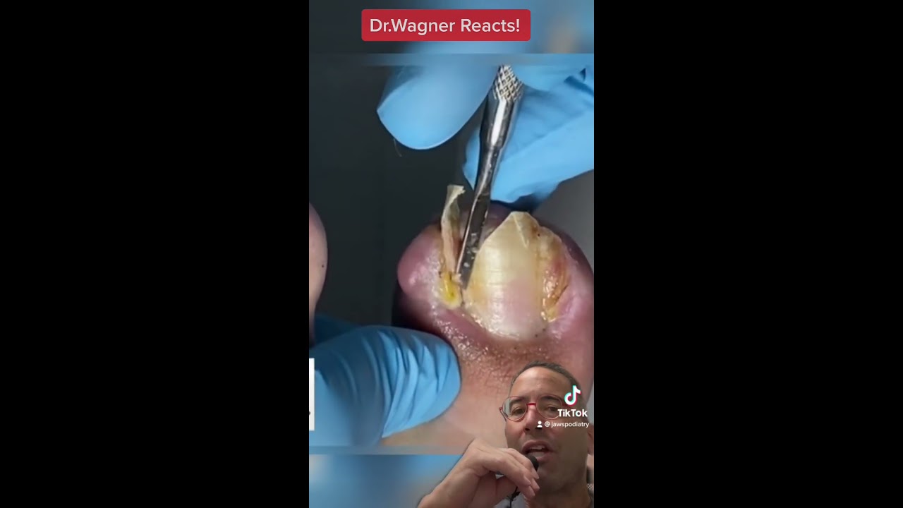 MONSTER INGROWN TOENAILS Shorts Ingrowntoenail