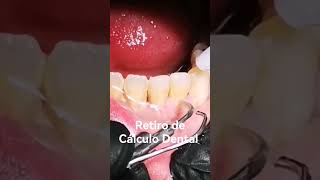 #short Retiro de Cálculo Dental 👅 #dentaltips
