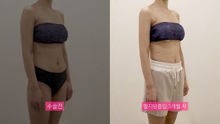 바비라인의원 팔지방흡입 3개월  전후영상