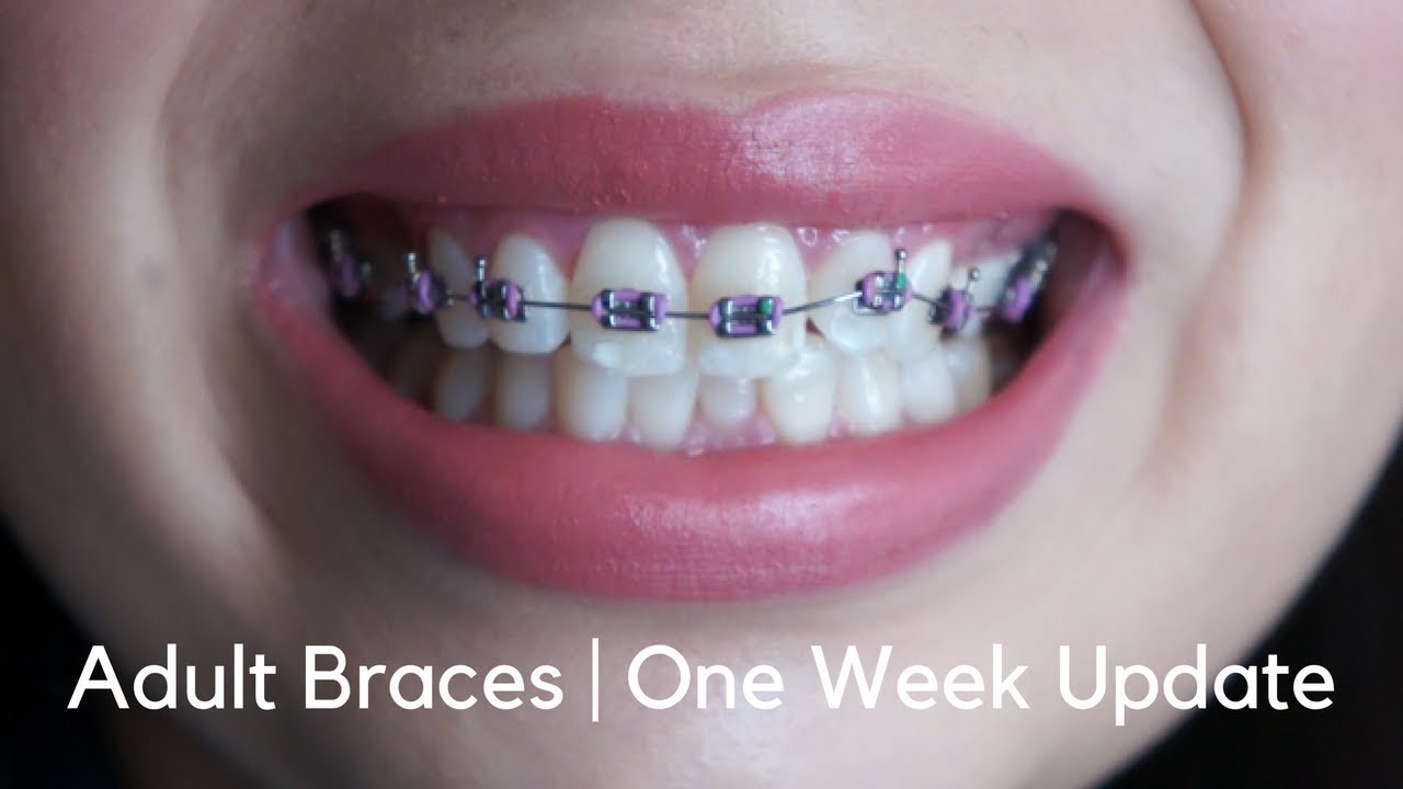 Adult Braces One Week Update YouTube