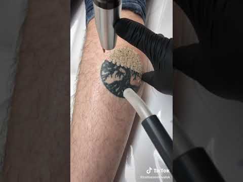 tattoo removal