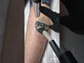 Tattoo removal