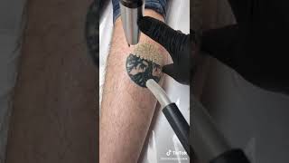 Tattoo Removal