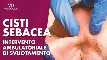 Come asportare una cisti?