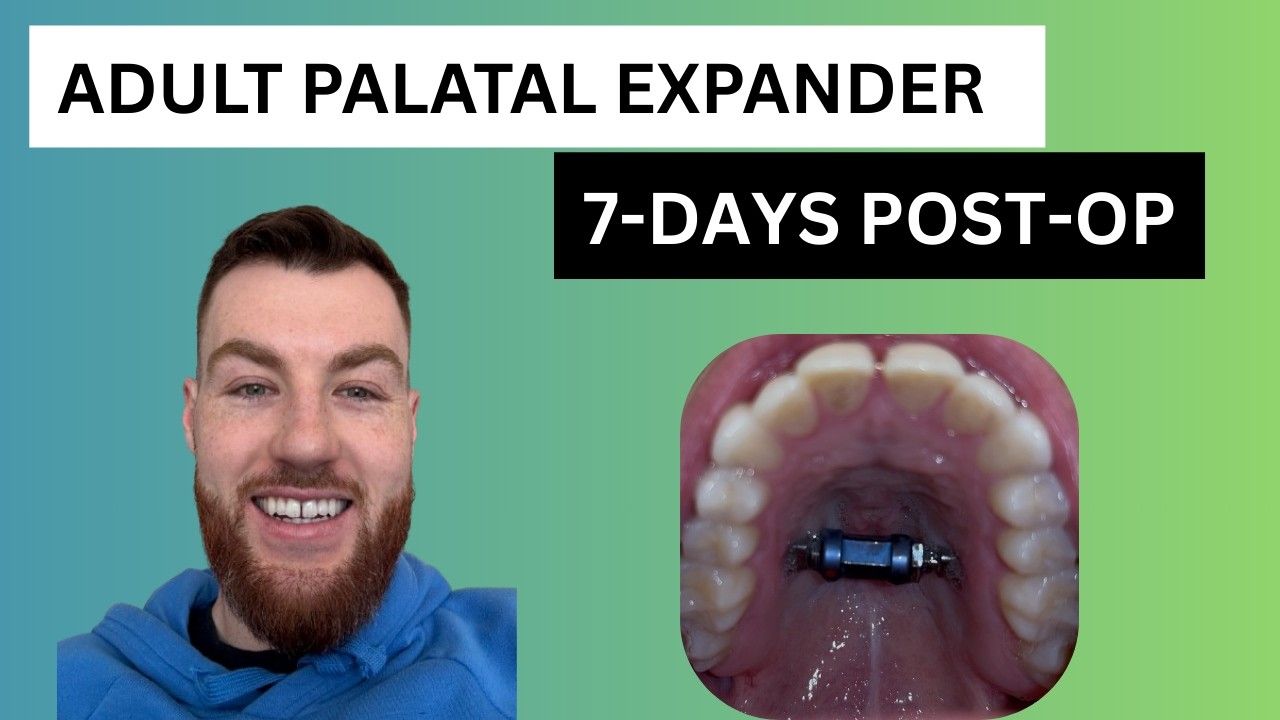 Adult Palatal Expander Surgery: 7 Days Post-Op