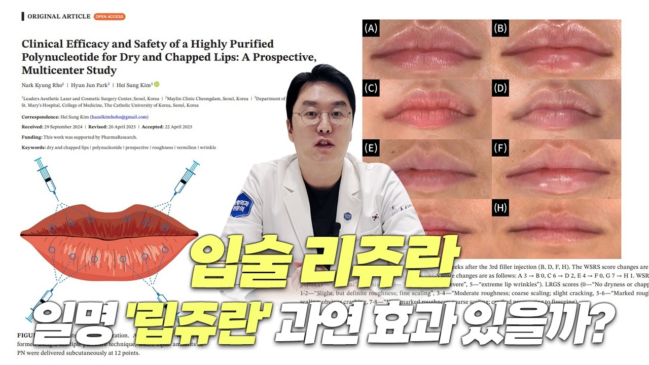 [논문 리뷰] 요즘 핫한 시술 '립쥬란' 과연 효과는 어떨까?