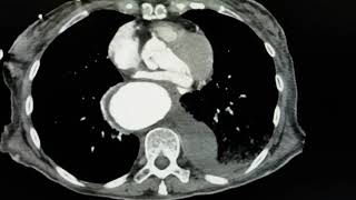 An Unusual Case Of Hematemesis Aortic Aneurysm Axial Ct Jetem 2018
