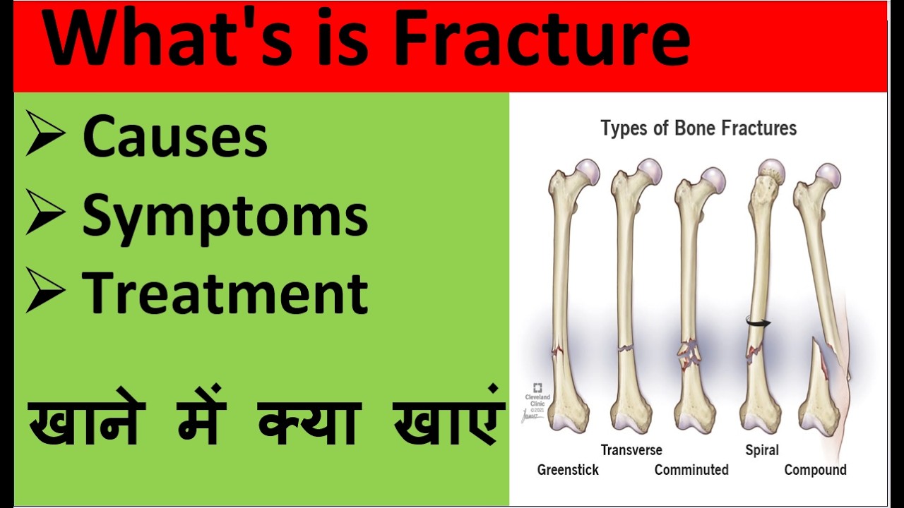 Wht Is A Frac What is a Fracture? Types, Causes & Treatment Explained - YouTube