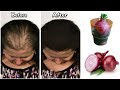 How to use onions for hair growth makes hair grow non-stop / the best Indian secret for hair growth